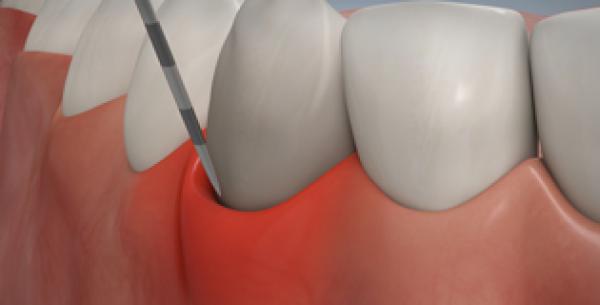 Zahnfleischbluten: Ursachen, Behandlung und Vorbeugung.