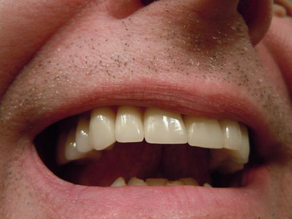 Zahnkrone - was ist zu beachten? 