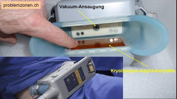 Wegfrieren wenn Wegschwitzen nichts mehr nützt