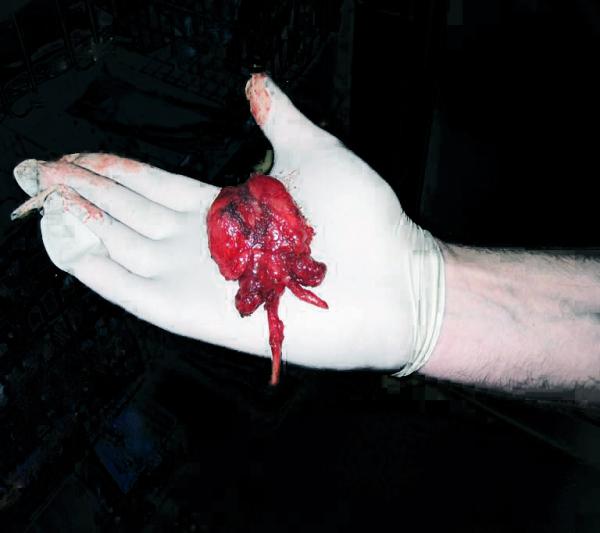 Die häufigsten Probleme mit  der Prostata