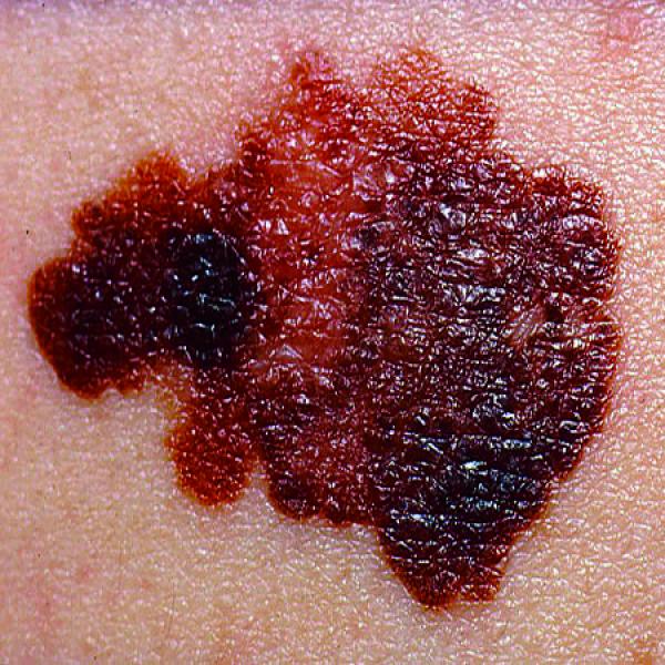 Sterben wir alle auf Krebs?