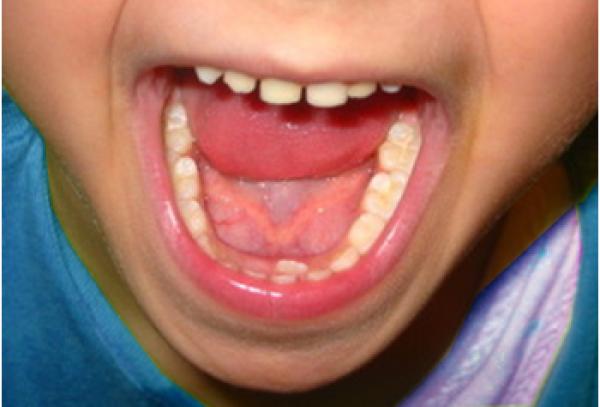 Ozontherapie: Kariesbehandlung, ohne bohren zu müssen. Schmerzfrei!