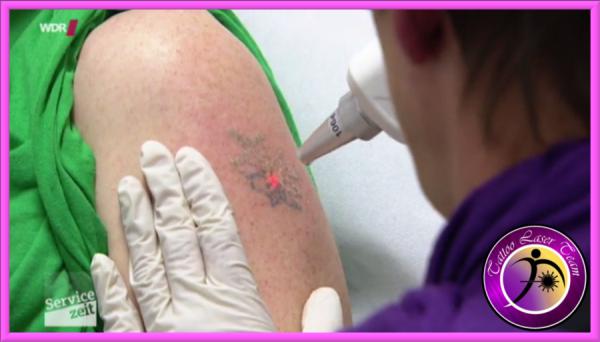 Fakten zur Laser Tattooentfernung