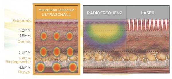 Bindegewebe stärken - mit Hilfe von Ultraschall?
