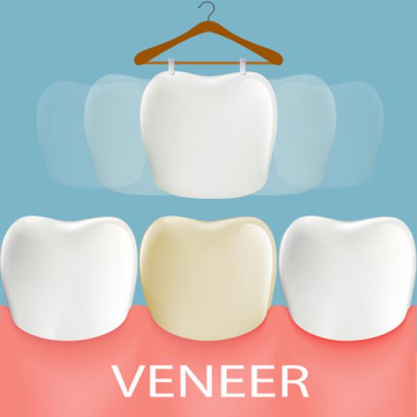Was kosten Veneers?