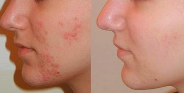 Akne - (K)ein Problem