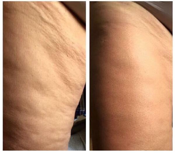 Der Name ByeByeCellulite sagt alles über die Wirkung der Creme