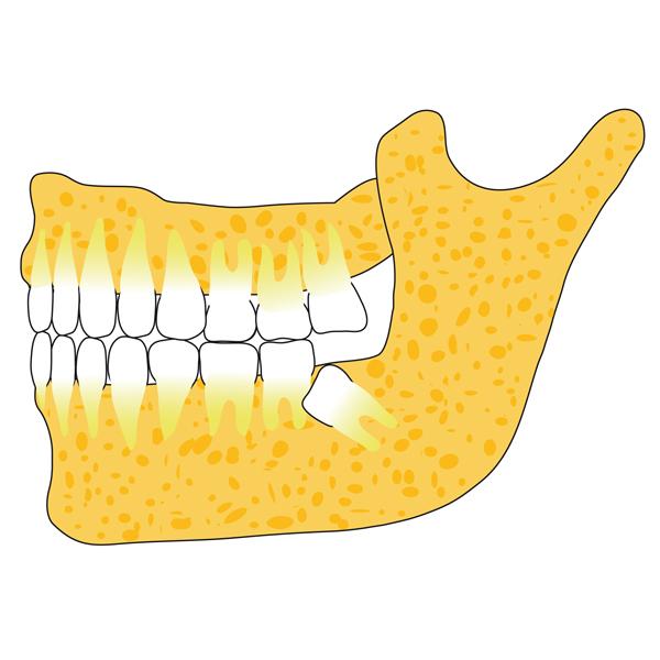 Weisheitszahnentfernung - wann notwendig und sinnvoll?