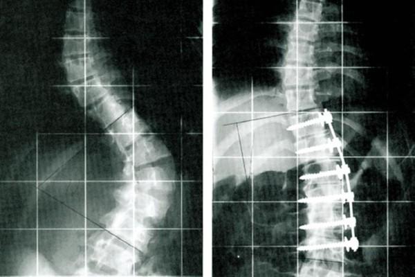 Mit einer Wirbelsäulenversteifung Beweglichkeit zurück gewinnen.