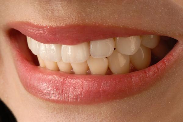Farb- und Formkorrektur mit keramischen Verblendschalen (Veneers)