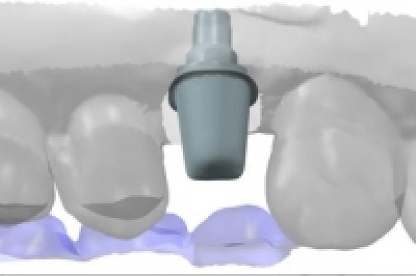 Keramik Implantate - für wen, wann, warum?