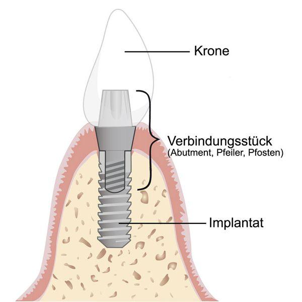 Welche Komplikationen können bei der Implantologie auftreten?