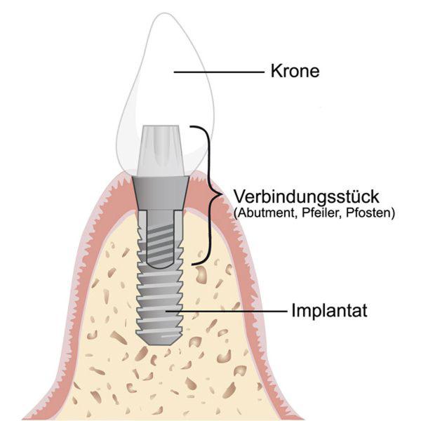 Was kostet ein neues Zahnimplantat?