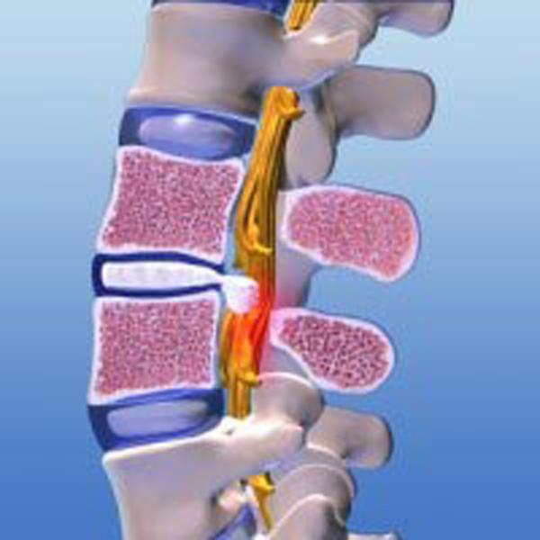 Minimalinvasive Bandscheibenoperation - eine Erfolgsgeschichte