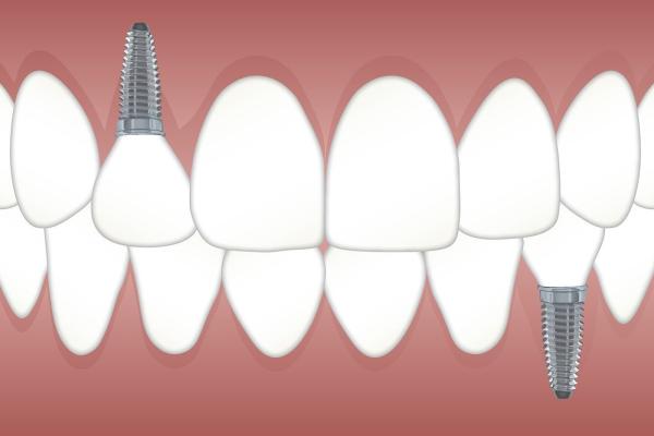 Warum Zahnimplantate (meist) der aktuell beste Zahnersatz sind