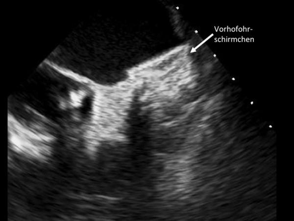 Vorhofflimmerablation oder abwarten - Kardiologe informiert