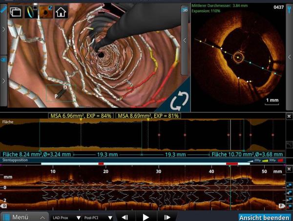 Kardiologie: Mitraclip-Patienten brauchen enge Nachsorge