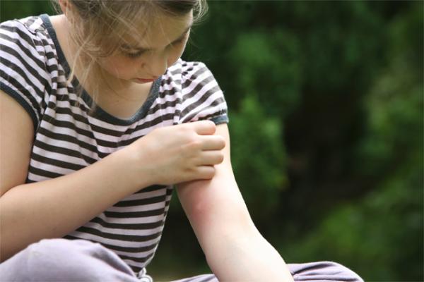 Die Haut juckt, ein Stich ist sichtbar. Jetzt gilt: nicht kratzen. Mückenstiche verhindern - Verbraucherinformation der DKV
