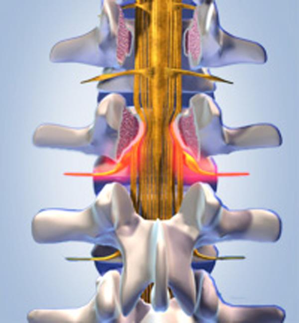 Spinalkanalstenose - Wann kann eine Operation Abhilfe schaffen?