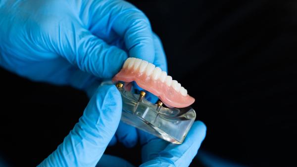 Gibt es Alternativen zu Implantaten mit denen sich ein Zahnimplantat vermeiden lässt?