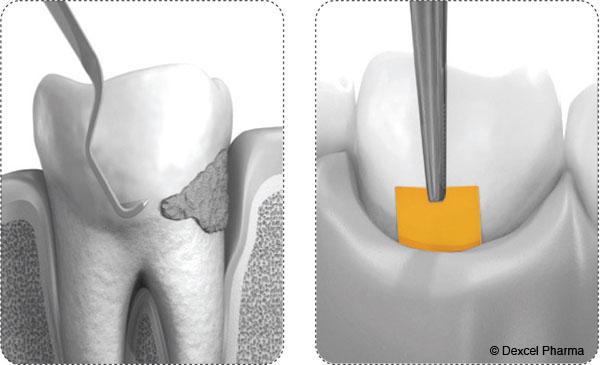 Neue Methode der Parodontosebehandlung in der Zahnarztpraxis Dr. Pink